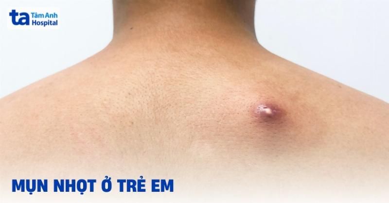 Lý do tại sao mụn nhọt lại cần chú ý đến chế độ ăn uống